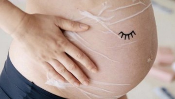 Mascarillas para evitar las estrías durante el embarazo